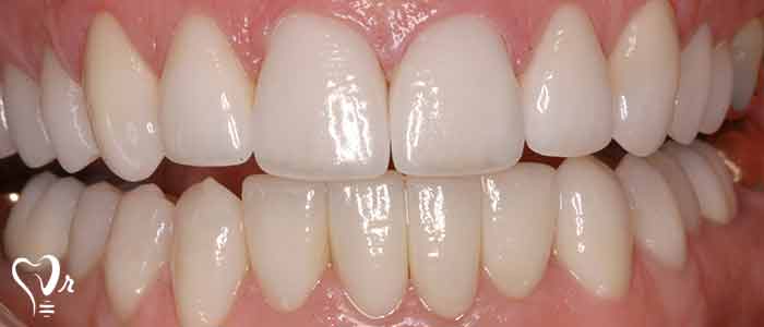 فاز نگهداری پریودونتال - پاکت های ارزیابی شده چه تغییراتی را نشان می دهند؟