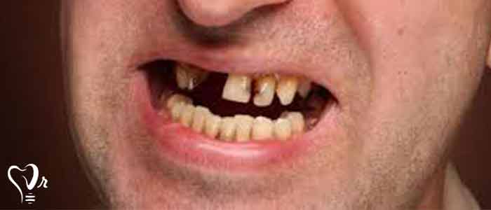 دیابت و دندانپزشکی - گلوکز خون