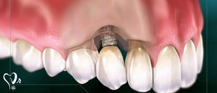  پری ایمپلنتایتیس چیست؟ درمان  پری ایمپلنتایتیس چگونه است؟  - ضایعه التهابی