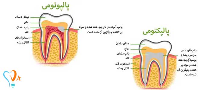 تفاوت پالپکتومی و پالپوتومی