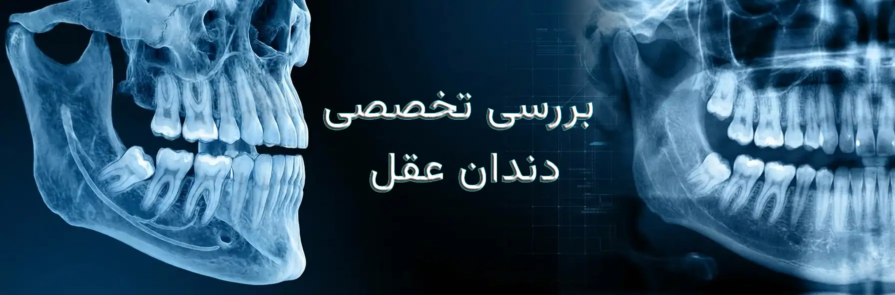 قیمت جراحی دندان عقل