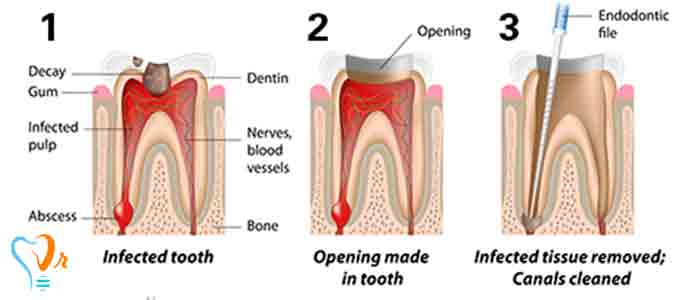 مراحل درمان ریشه چیست؟ - معاینه و بررسی دندان