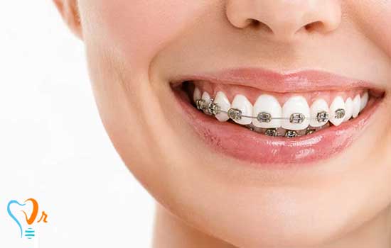 ارتودنسی دندان چیست؟ انواع، مزایا و هزینه ارتودنسی