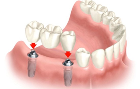 Dental Implants