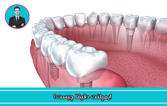 آیا می دانید ایمپلنت دقیقا چیست؟
